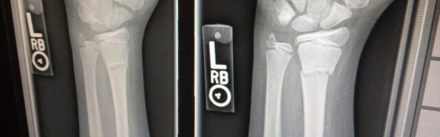 Hibridni makrofagi mogli bi da obnove kost nakon preloma