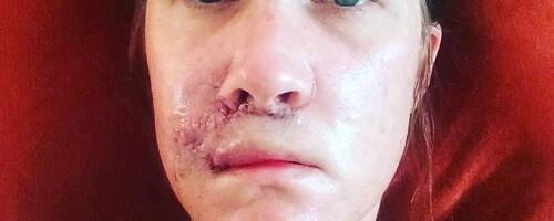 Probudila sam se tokom operacije i sada mi je lice deformisano: Za sve je kriva bubuljica na mojoj usni