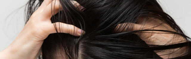 Zašto nas SVRBI TEME i kako da ga smirimo: Stručnjaci otkrivaju najčešće uzroke problema sa kožom glave