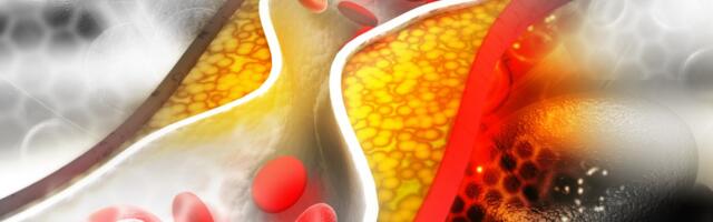 Imate visok holesterol? Ovih 7 namirnica morate ograničiti - jetra će vam biti zahvalna, a dobra je i 1 dijeta