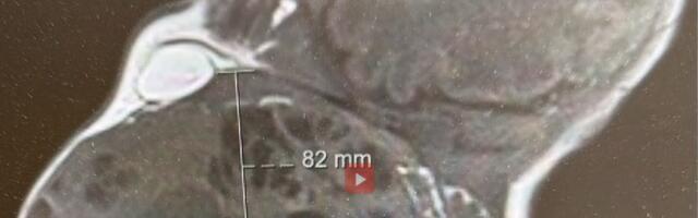 "IZVAĐENA JE GLAVA, ONA JE OSTALA VEZANA ZA POSTELJICU, A ONDA...." Bebi u stomaku narastao tumor veličine glave: Tu su na scenu stupili lekari i izveli čudo