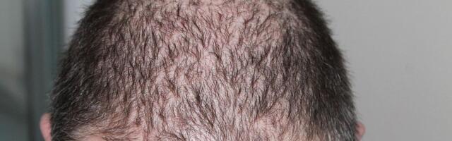 Predsednik Južne Koreje traži da javno osiguranje pokriva i tretmane protiv gubitka kose