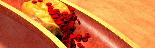 Šta bi svako stariji od 30 godina trebalo da zna o novim smernicama za holesterol