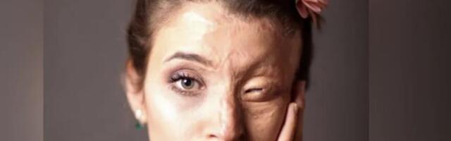 Čuvena Iranka bila je mlada i lepa kad su joj zbog "lošeg hidžaba" bacili kiselinu u lice: Ono što je usledilo peklo je više od rana