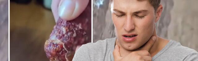 Tinejdžer (16) pojeo kobasicu, pa umro: On je prva osoba na svetu koja je preminula od "alergije 21. veka"