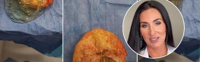 Doktorka pokazala silikone stare 35 godina, baš ružno (VIDEO)