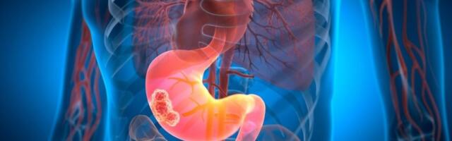 Navika koja povećava rizik od najsmrtonosnijeg raka: Mnogi redovno greše - obratite pažnju