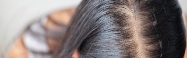 Industrija preparata protiv opadanja kose vredi 9 milijardi, ali nauka tvrdi da rešenje nije u apoteci