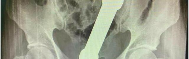 ŽALIO SE NA BOLOVE Lekari zanemeli kad su videli rendgenski snimak: Iz rektuma mu izvađen teg od 2 kilograma!