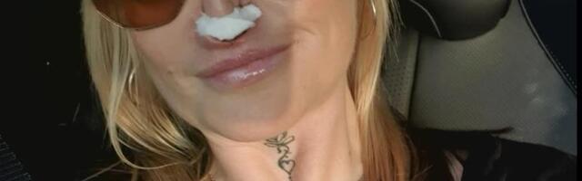 Otišla na korekciju zuba, pa zbog jake infekcije ostala bez dela nosa: Tokom intervencije anestezija nije delovala prošla je kroz pakao