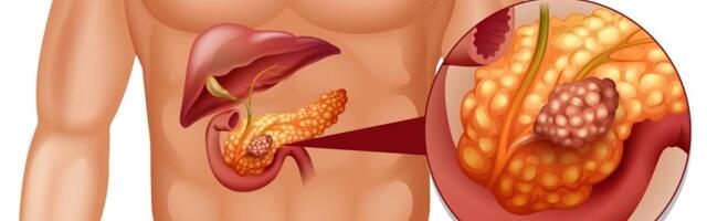 Rak pankreasa: rani simptomi koje mnogi ignorišu, a mogu spasiti život