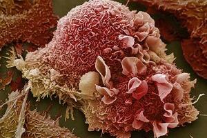 Велико откриће у борби против рака – откривени тајни агенти у генима који помажу туморима