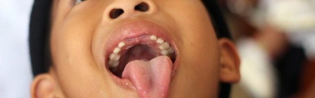 NOVI OPASNI TIK TOK IZAZOV! Deca magnete stavljaju na jezik umesto pirsinga, dečak se bori za život