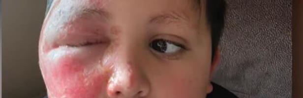 Dečak zadobio teške opekotine zbog TikTok trenda: Sprljio pola lica i šake, ideju mu dao drugar iz škole (Foto)