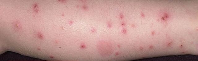 Mještani Selakovca ne izlaze iz kuće zbog najezde buva: “Djeca izujedana, strah se širi kroz naselje” (VIDEO)