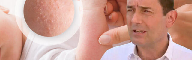 DA LI JE OSIP OD VRUĆINE KOD BEBA RAZLOG ZA UZBUNU i kako da ga razlikujete od boginja i alergije: Pedijatar otkriva ključni znak da preti opasni toplotni udar