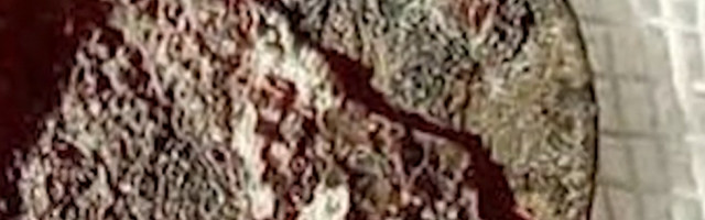 Sasvim slučajno mu u nosu pronašli novčić koji je tamo "zaturio" još kao dečak (VIDEO)