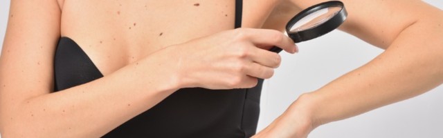 Samopregled mladeža: ABCDE pravilo protiv melanoma