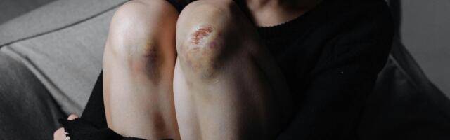 7 načina da se na prirodan način rešite modrica