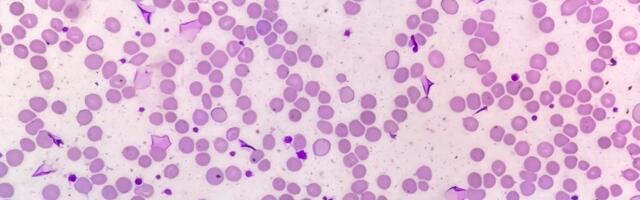 Revolucionarno otkriće: Nova terapija uništila vrstu raka koja je do sada bila neizlečiva