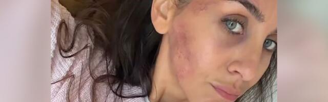 Ivana Dudić sa modricama i ogrebotinama na licu zabrinula pratioce: Glumica otkrila šta joj se dogodilo