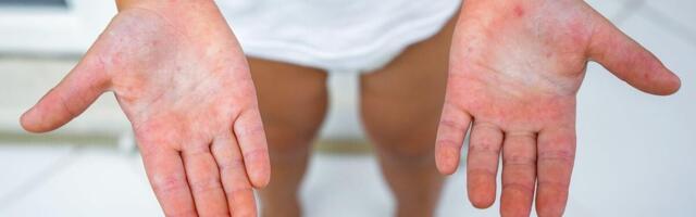 Koksaki virus hara među mališanima u Srbiji, roditelji ga često mešaju sa boginjama: Ovo su ključne razlike!