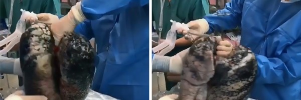 Nakon 30. godina pušačkog staža pacijent donirao svoja pluća