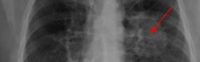 REVOLUCIJA: Veštačka inteligencija može RANIJE da otkrije rak pluća, evo i kako