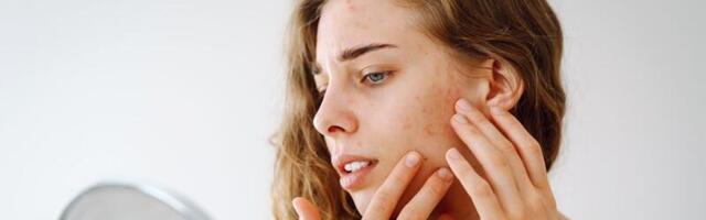 Da li mlečni proizvodi izazivaju akne? Evo šta kažu dermatolozi!