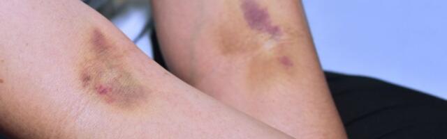 Ovo su uzroci nastanka modrica nakon vađenja krvi: Znak da morate hitno da se javite lekaru