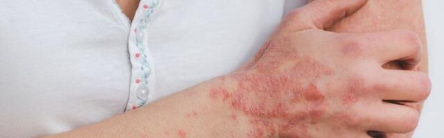 Sunčanje, uz oprez, može da ima pozitivan efekat na psorijazu