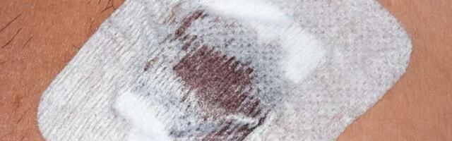 Ostao bez bradavica zbog izazova sa dezedoransima