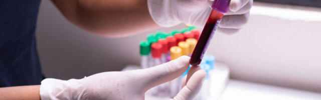 Једноставан тест крви може да предвиди најбољи третман рака дојке