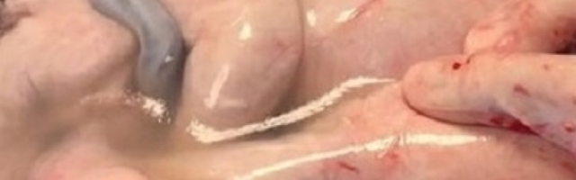 On je došao u amnionskoj kesi, a onda je stigla ona i iznenadila lekare! (VIDEO)