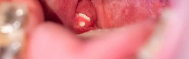 Sve što treba da znate o kamenju u krajnicima