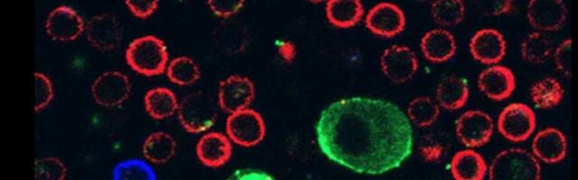 Otkrivanje mehanizma kojim ćelije melanoma parališu imunske ćelije