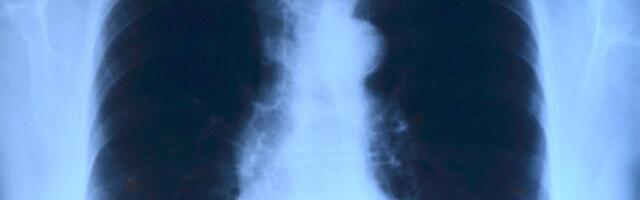 U Srbiji prošle godine registrovano 410 slučajeva tuberkuloze