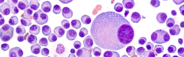 Ne ignorišite ove simptome: Mogu biti znak multiplog mijeloma