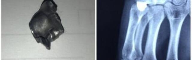 Ovo je metak koji je izvađen iz šake srpskog mladića: Objavljen i rendgenski snimak