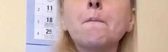 PRIMETILA BUBULJICU NA USNI, PA SAZNALA DA IMA RAK! Lekari joj ODSTRANILI DEO LICA, a nakon 5. operacije...