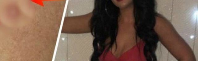 DEVOJKE, PAZITE SE OVIH PLIKOVA POSLE SOLARIJUMA! Ova žena je išla 3 do 5 puta nedeljno - ŽESTOKO JE ZAŽALILA!