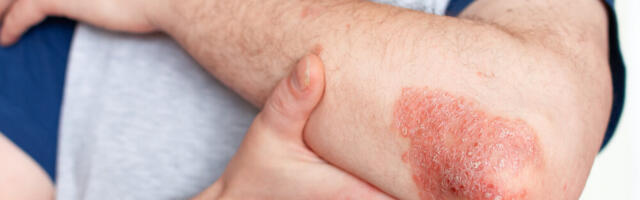 Udruženje pacijenata pozvalo obolele od psorijaze da preuzmu aktivnu ulogu u lečenju