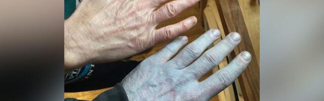 Probudio se POTPUNO PLAV i hitno otišao u bolnicu: Nakon pregleda lekari su počeli da se SMEJU!