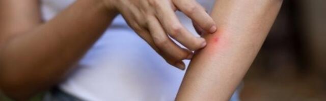 Jedan znak na koži otkriva sve: Prepoznajte opasne ujede insekta - evo kako da znate šta vas je napalo