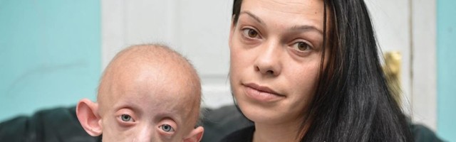 Imala je telo osobe od 144 godine, a tek je postala punoletna - preminula tinejdžerka koja je bila pravi Bendžamin Baton