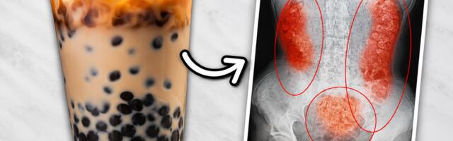 „Bubble Tea“ uništava bubrege: Lekari izvadili devojci više od 300 kamenaca