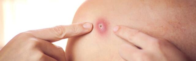 7 bolesti koje uzrokuju kvržice na telu: Ovo su najčešći uzroci, nisu svi razlog za paniku