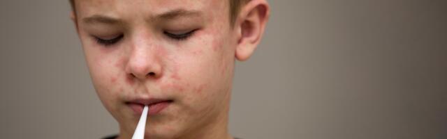 Izbila epidemija malih boginja u severnom Londonu, zaraženo više od 60 dece