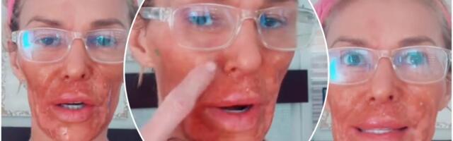 Rijaliti zvezda sva u ranama otkrila da joj je plastična operacija došla glave: Ostala je bez zuba, a sve zbog silikona