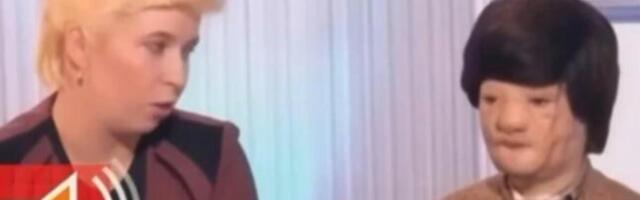 IGORA JE MAJKA OSTAVILA SA STAFORDOM, KAD GA JE PAS BRUTALNO NAPAO: Pola lica mu je unakaženo, jedva preživeo napad